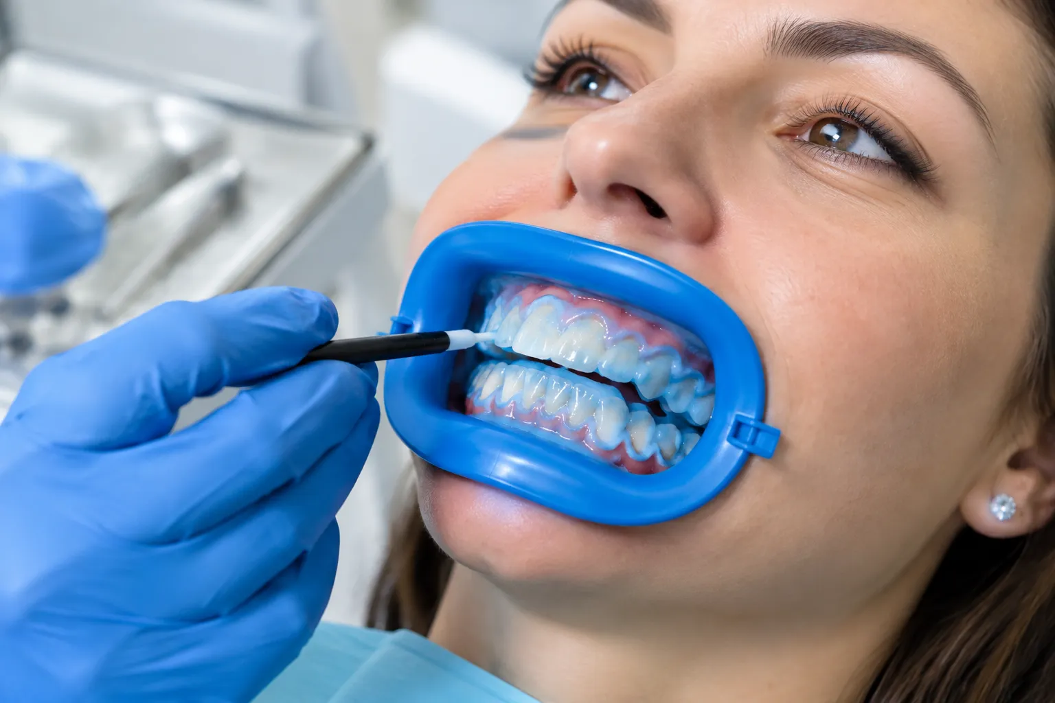 Blanqueamiento dental profesional con protección de encías